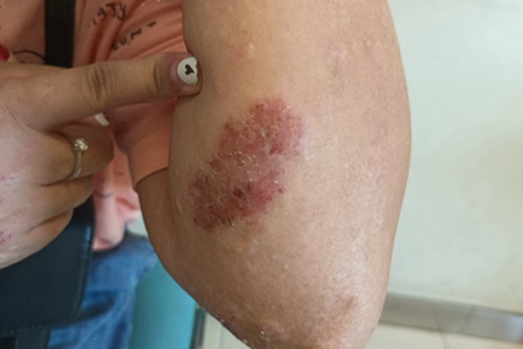 亚急性湿疹胳膊糜烂图