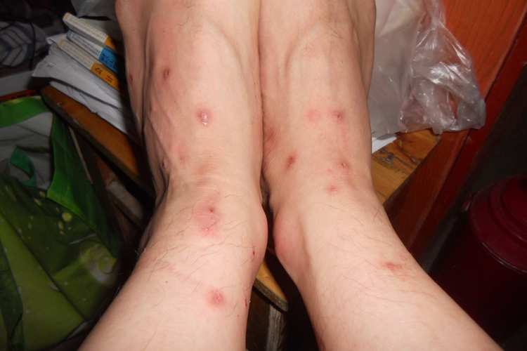 虱病脚背血痂图