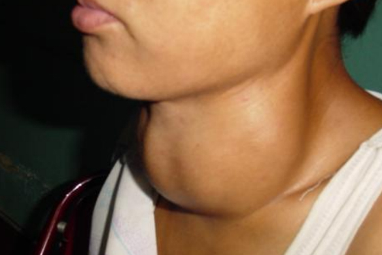 Ⅲ度甲状腺肿大图