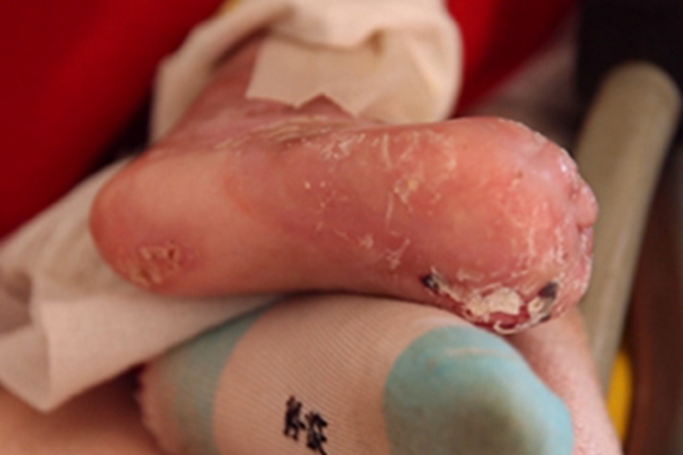 大疱性表皮松解症脚部畸形图 大疱性表皮松解症脚部畸形图