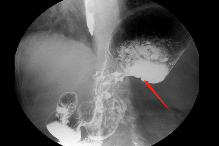 胃癌X线检查有龛影图
