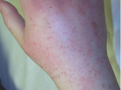 先天性风疹综合征手背上很多小红点点图.jpg