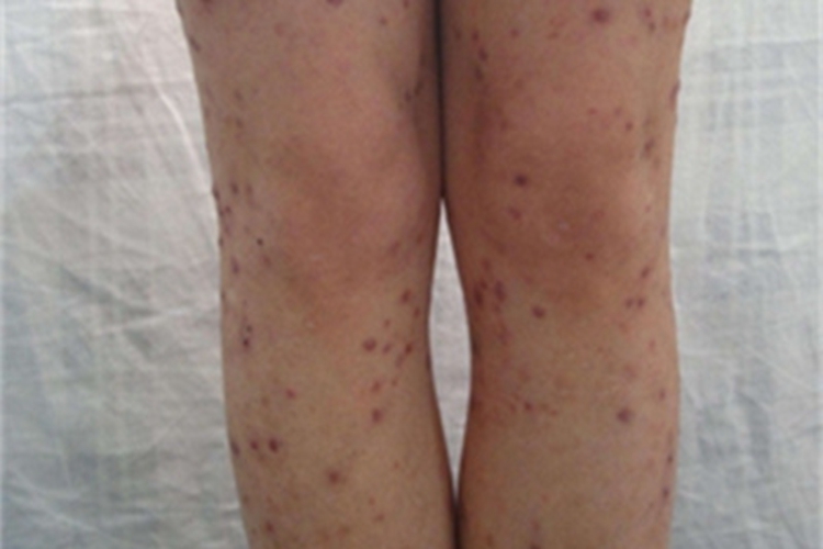 血吸虫病小腿症状图