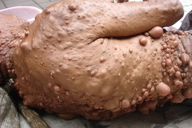 多发性神经纤维瘤图