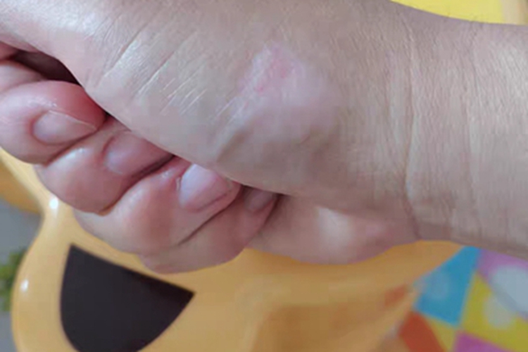 进展期节段型白癜风发白图 进展期节段型白癜风发白图