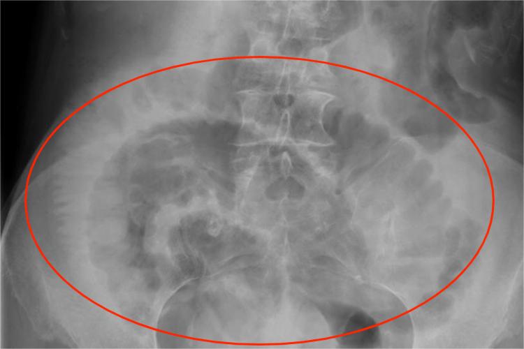 单纯性小肠梗阻X线影像图