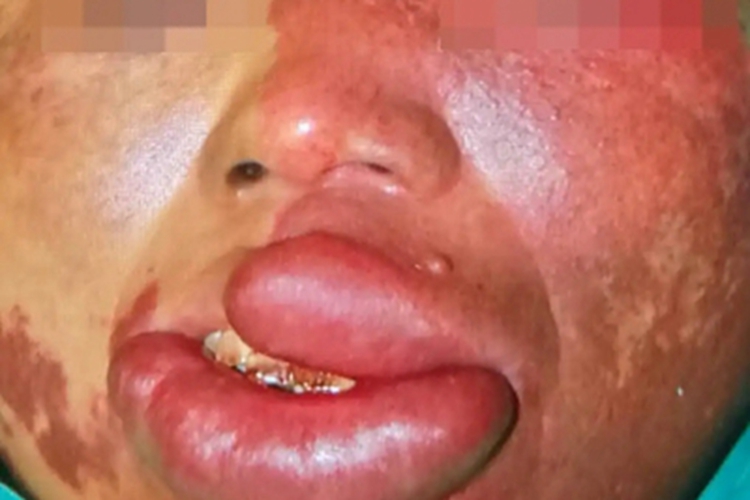 静脉畸形面部红肿图