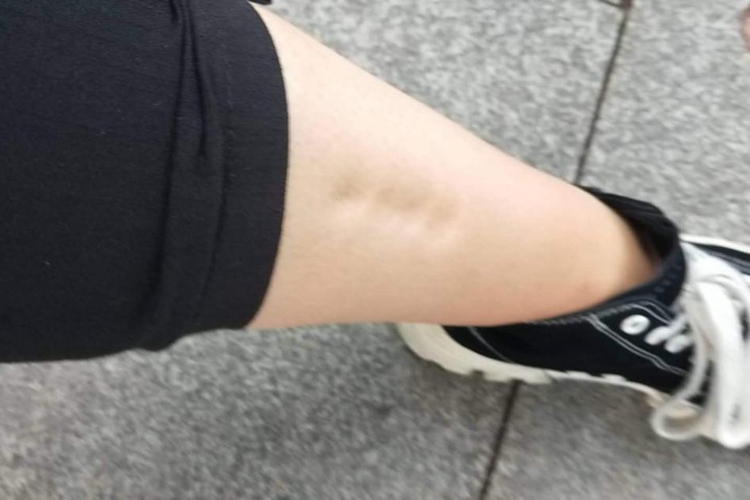 下肢凹陷性水肿图