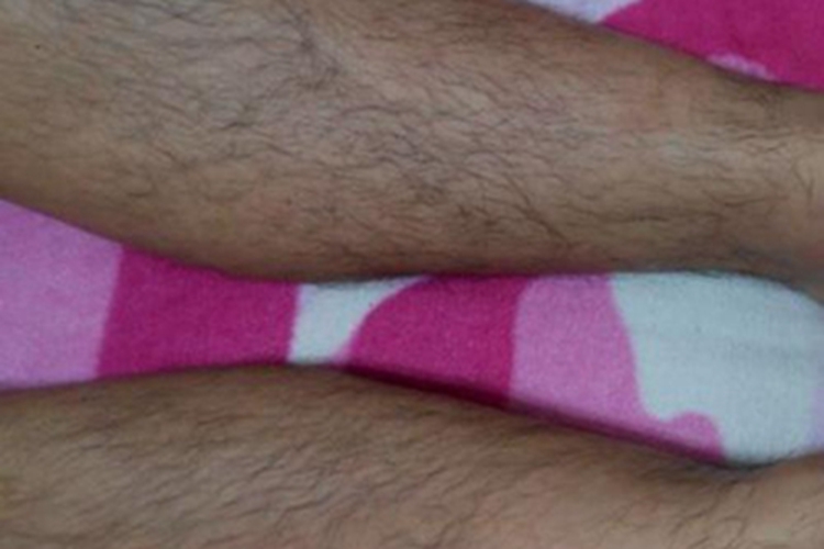 妇女多毛症小腿上长汗毛图 妇女多毛症小腿上长汗毛图