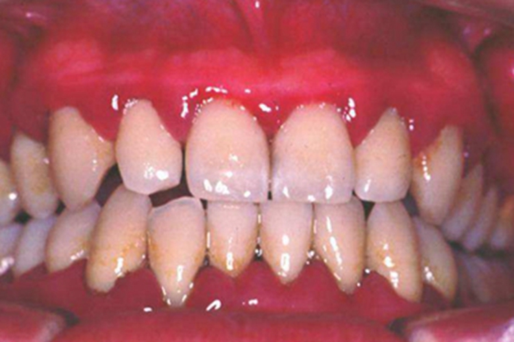 药物性牙龈肥大症状图 药物性牙龈肥大症状图