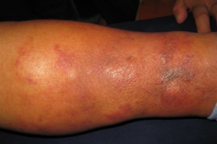 急性期皮肤丝虫病小腿红肿图