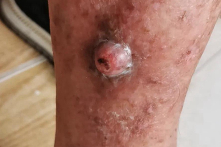 皮肤转移癌大包图 皮肤转移癌大包图