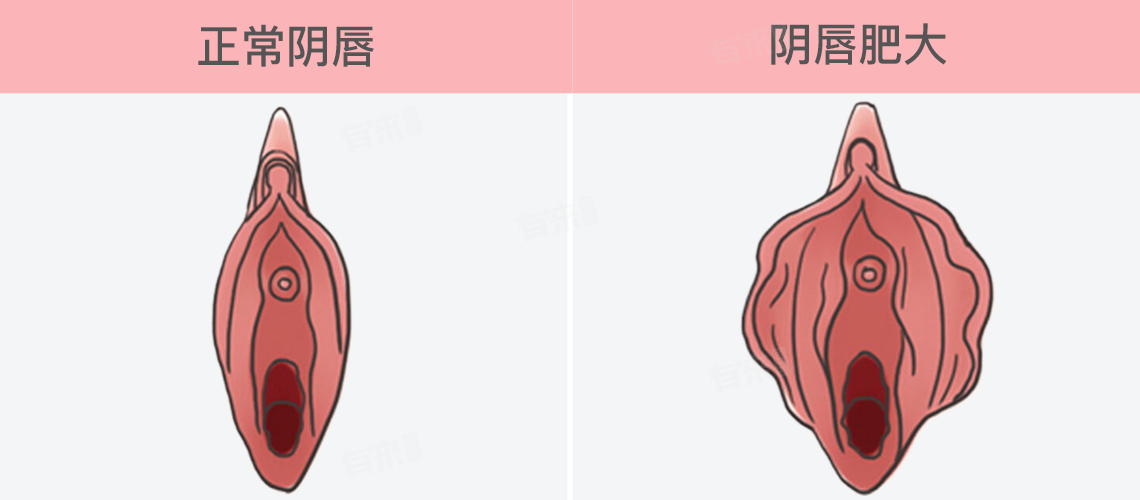 阴唇肥大图片