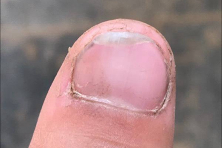 甲分离指甲局部镂空图 甲分离指甲局部镂空图