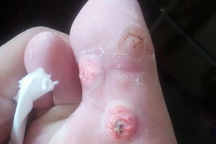 小孩子大脚趾边缘鸡眼图 小孩子大脚趾边缘鸡眼图