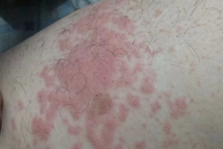 慢性湿疹腿症状图