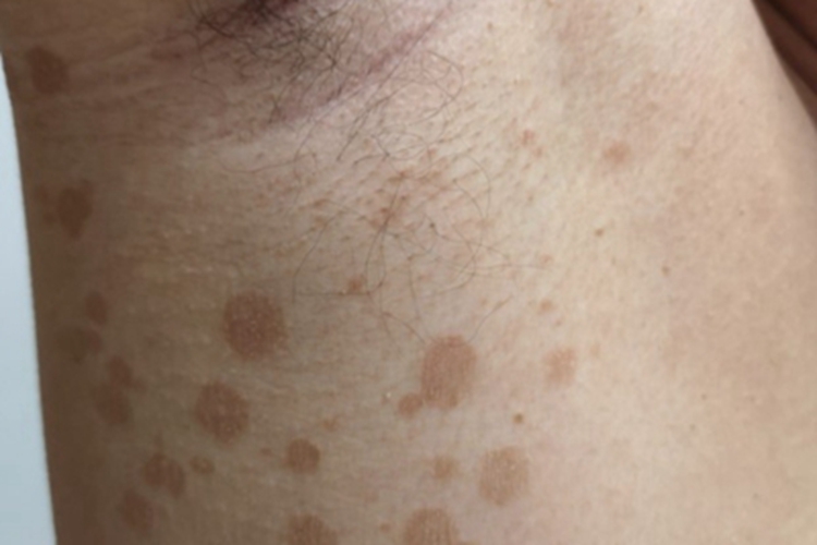 花斑糠疹腋下有很多斑点图 花斑糠疹腋下有很多斑点图