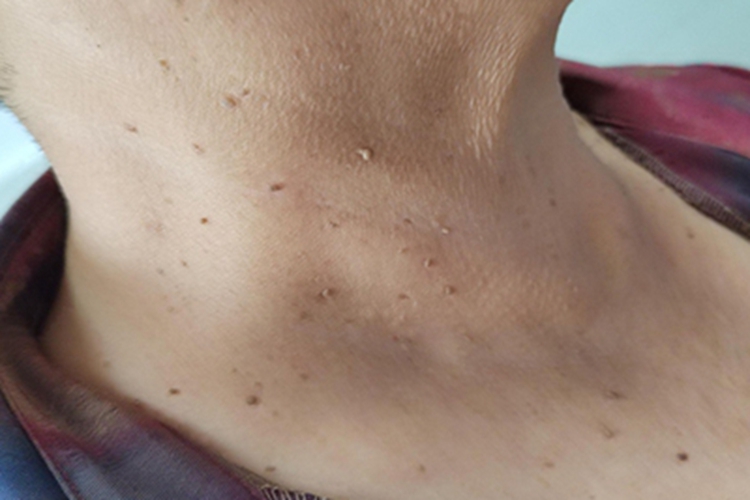 寻常疣脖子长小肉粒图