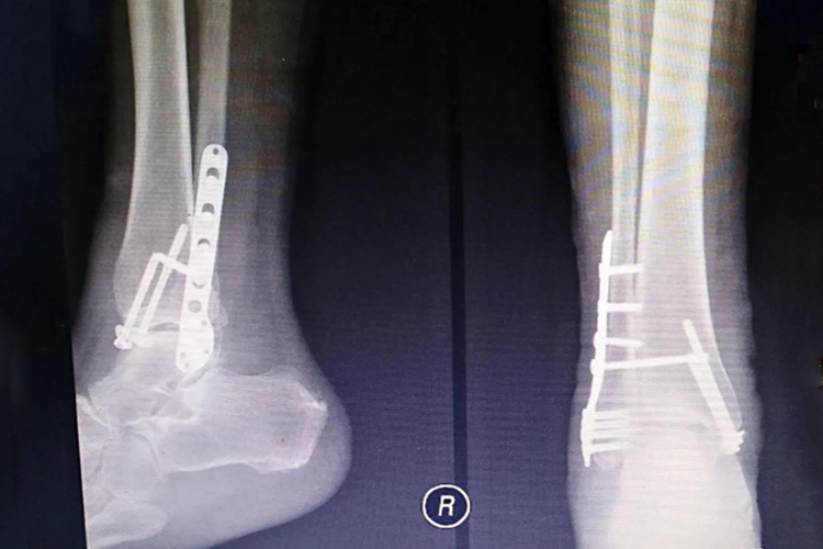 Ⅱ型骨折钢钉固定图