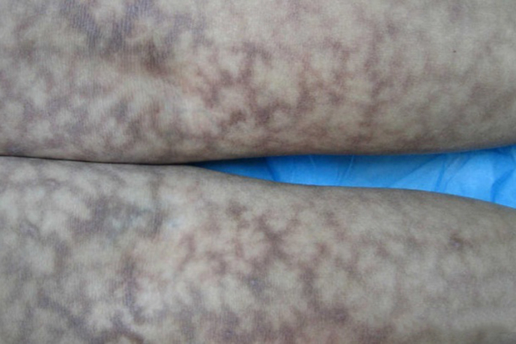 网状青斑血管炎图 网状青斑血管炎图