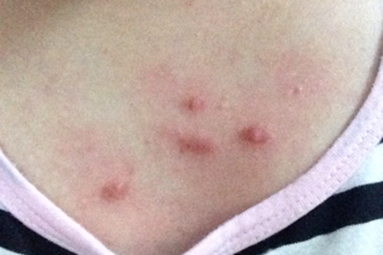 寻常痤疮胸部症状图