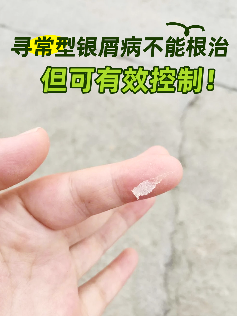 寻常型银屑病可以彻底治疗好吗？医生来解答