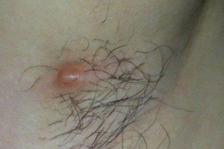 淋巴瘤样丘疹病腋窝丘疹图 淋巴瘤样丘疹病腋窝丘疹图