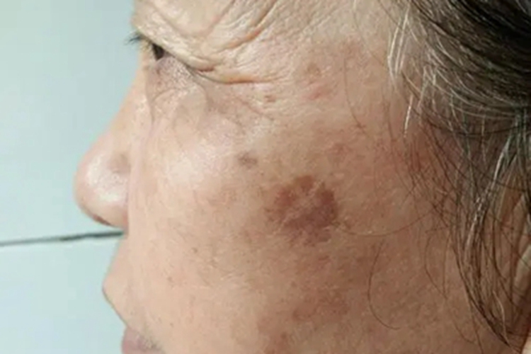 老年性皮肤萎缩斑图