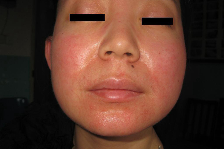 面部糖皮质激素依赖性皮炎图