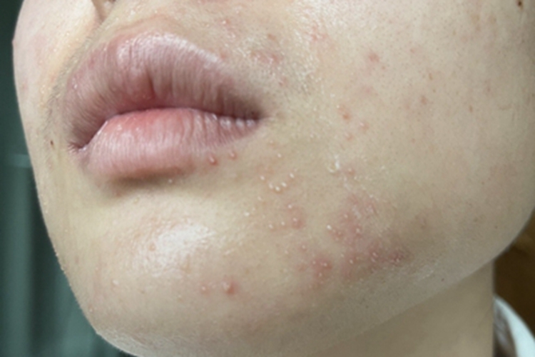 毛结节菌病下巴白点图