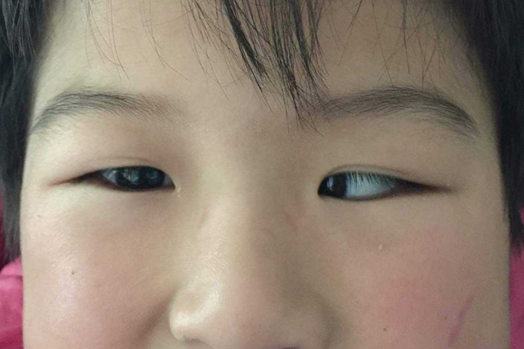 调节性左眼轻微内斜视图 调节性左眼轻微内斜视图