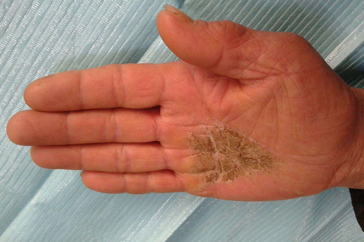 弥漫性掌跖角化症图