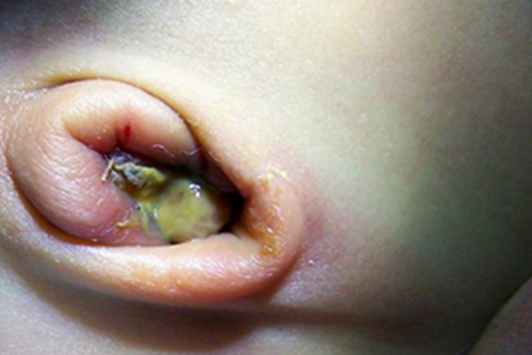 脐炎肚脐症状图 脐炎肚脐症状图