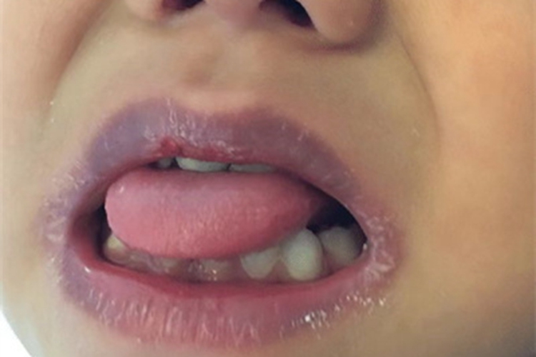 川崎病嘴唇发紫起干皮图