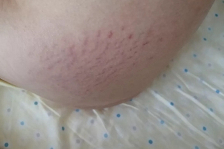 萎缩纹屁股上有红条纹像疤图