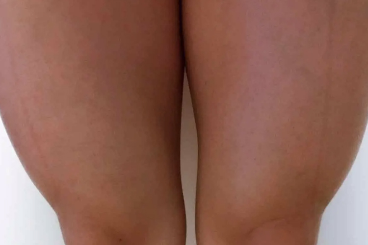 生理性大腿肌肉外翻图