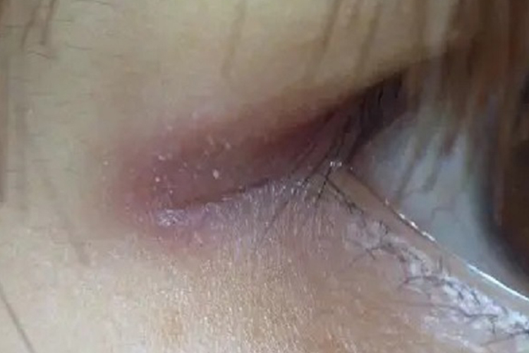 眦部睑缘炎图