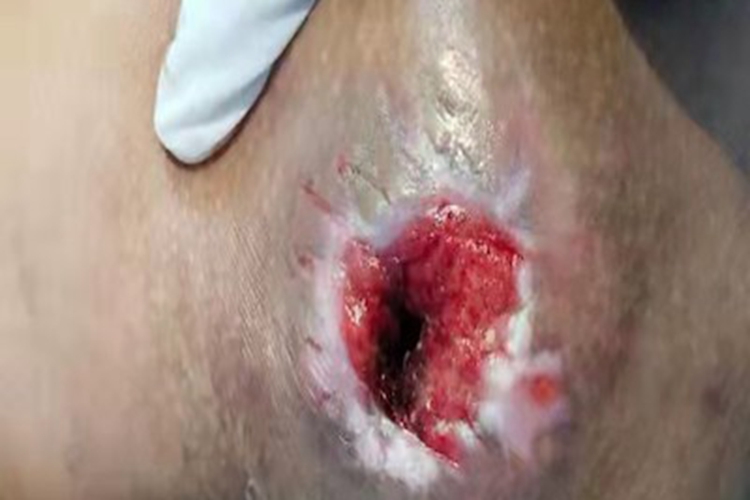 三期梅毒臀部溃疡图