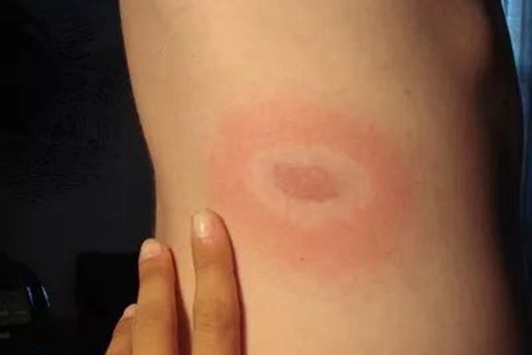 慢性游走性红斑腰部症状图