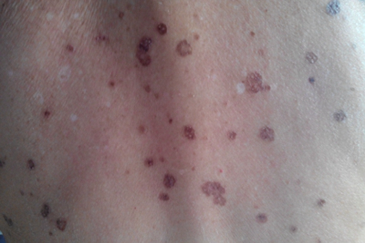 汗孔角化症背部斑图 汗孔角化症背部斑图