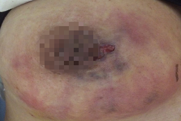 浆细胞性乳腺炎图 浆细胞性乳腺炎图