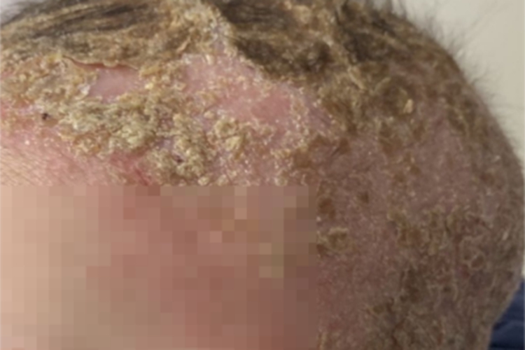 婴儿期特应性皮炎头皮症状图