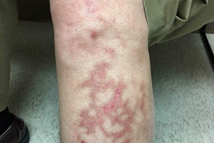 热激红斑小腿红斑图