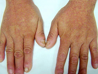 持久性豆状角化过度病的症状和图片 - 有来医生