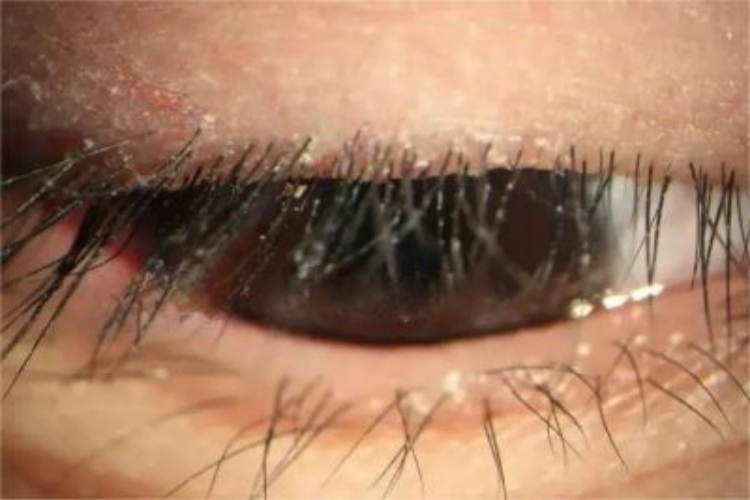 鳞屑性睑缘炎初期图 鳞屑性睑缘炎初期图
