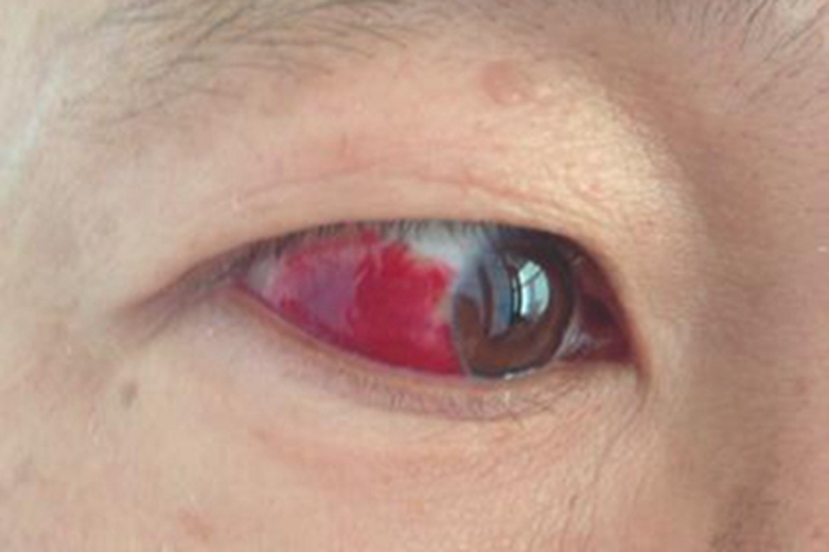 白血病眼球充血图 白血病眼球充血图