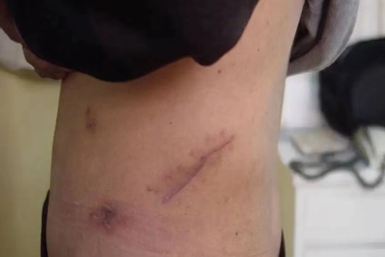 肾脏手术第11肋间刀口图