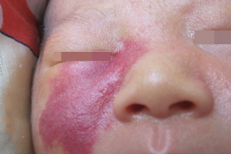 小儿血管瘤眼周症状图