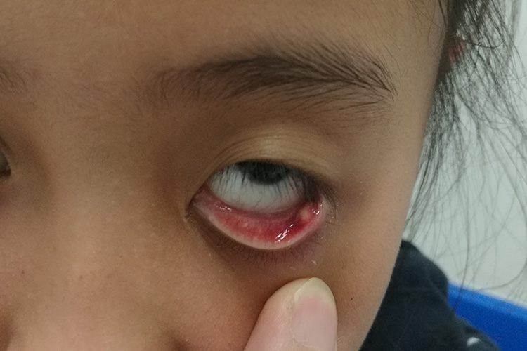 细菌感染可导致炎症的发生,炎症的刺激可导致眼部红,肿,热,痛等,从而