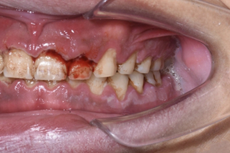 急性坏死性溃疡性龈炎糜烂图 急性坏死性溃疡性龈炎糜烂图